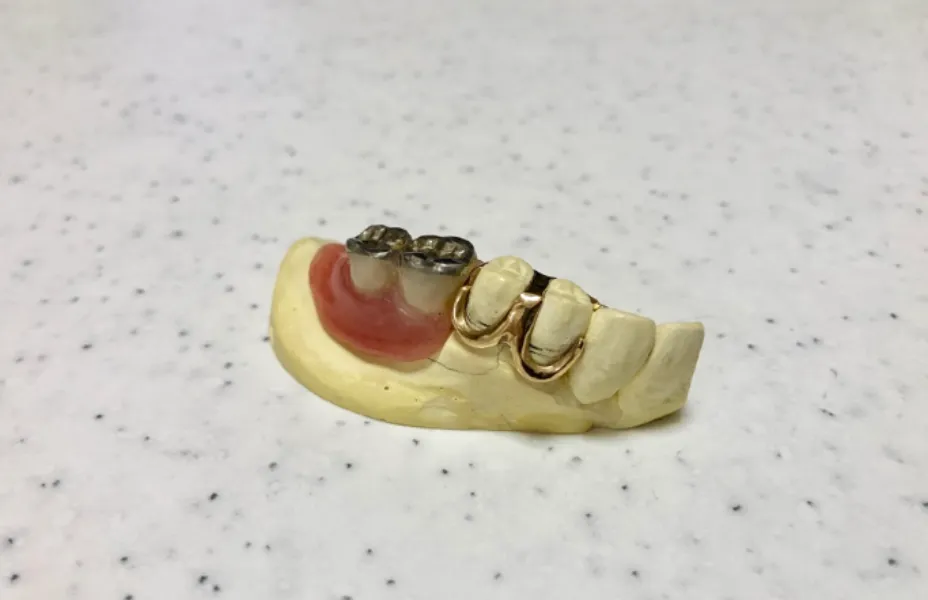 アタッチメント義歯