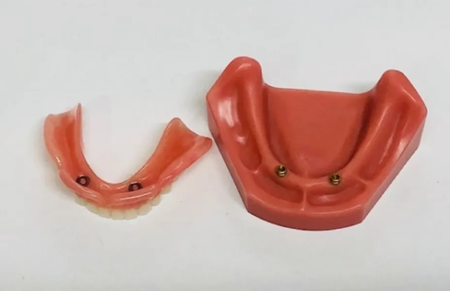 インプラント義歯